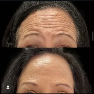Before And After Images Treatment by ReLux Medical Spa in Akron, OH