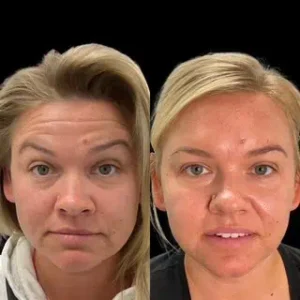 Before And After Treatment Images by ReLux Medical Spa in Akron, OH