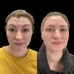 Before And After Images Treatment by ReLux Medical Spa in Akron, OH