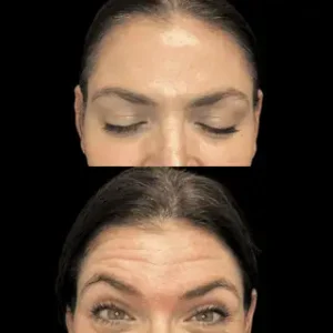 Before And After Treatment Images by ReLux Medical Spa in Akron, OH