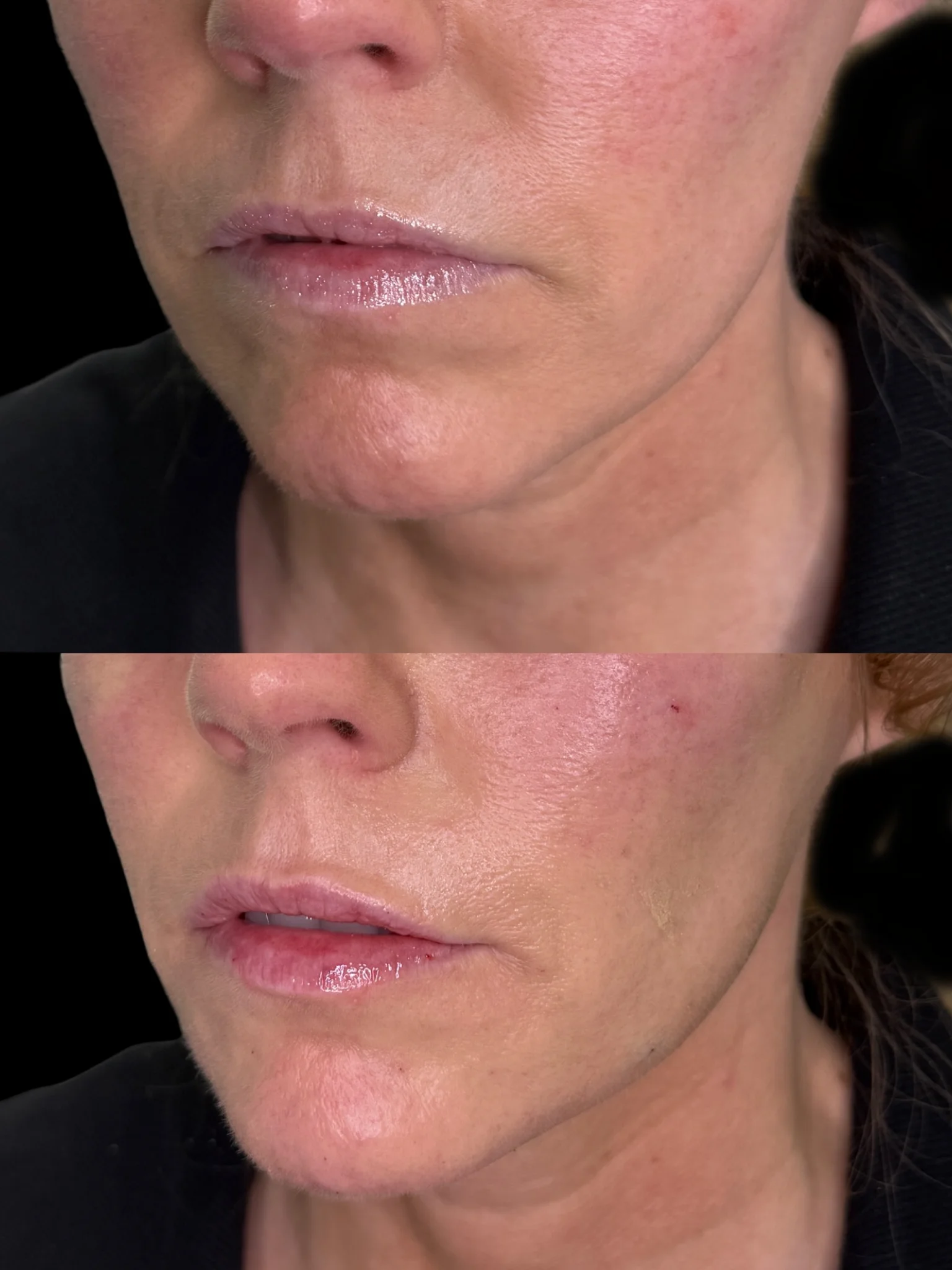 chin filler ba 2