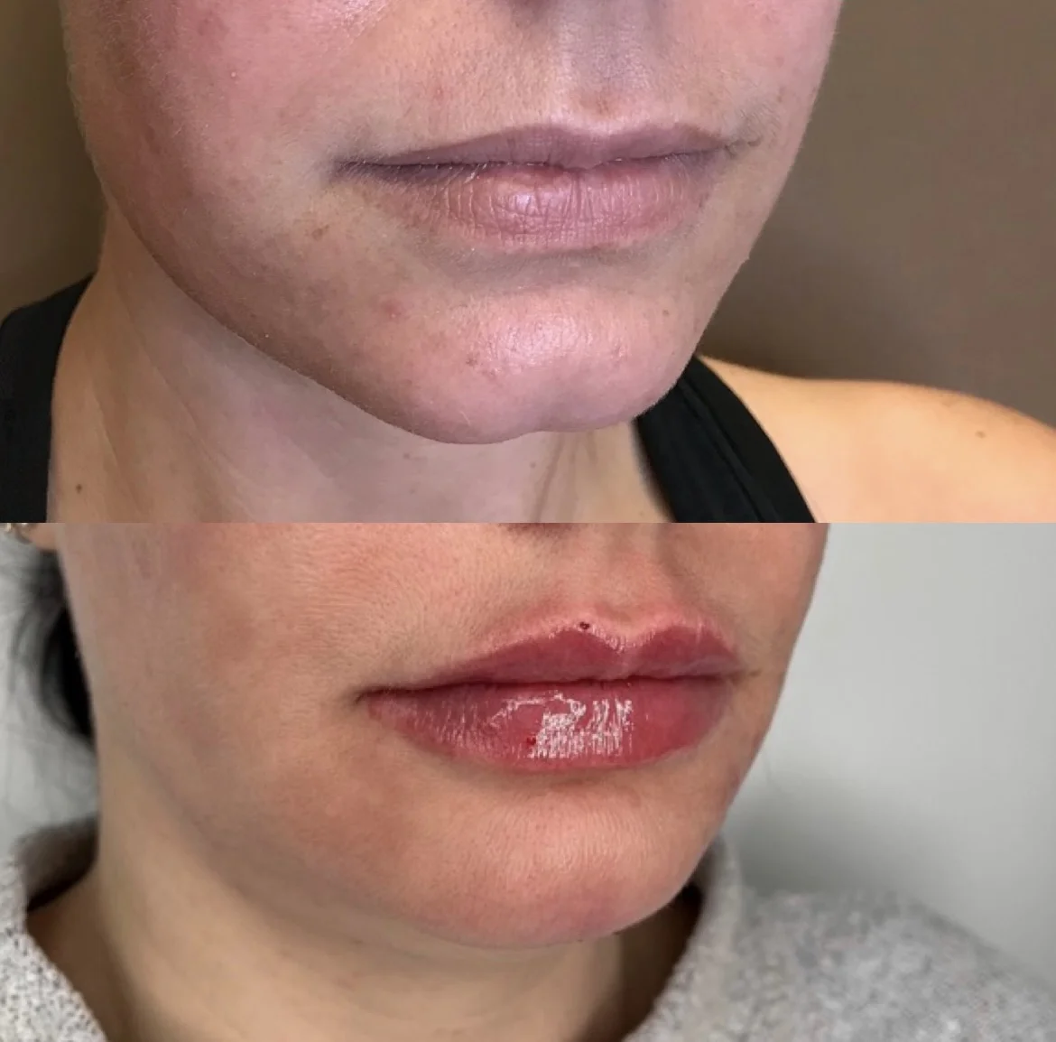 lip chin filler