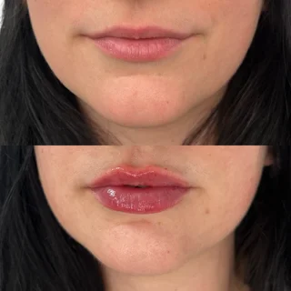 lip filler 2