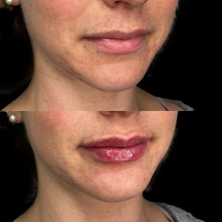 lip filler
