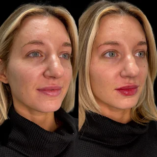lip filller ba