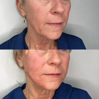 Before and After images
