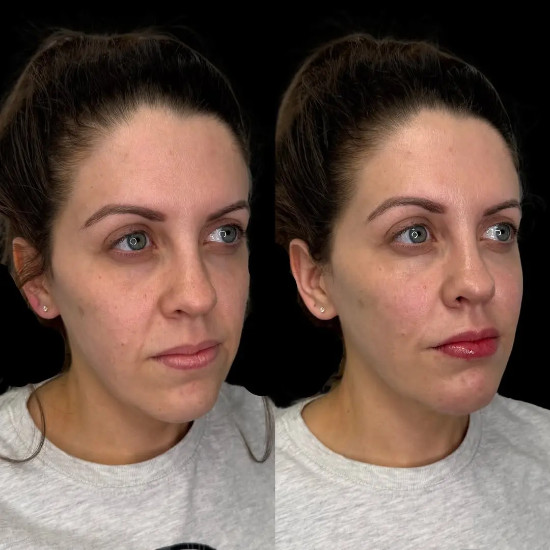 Facial Balancing in Akron, OH facail Balacing Before and after