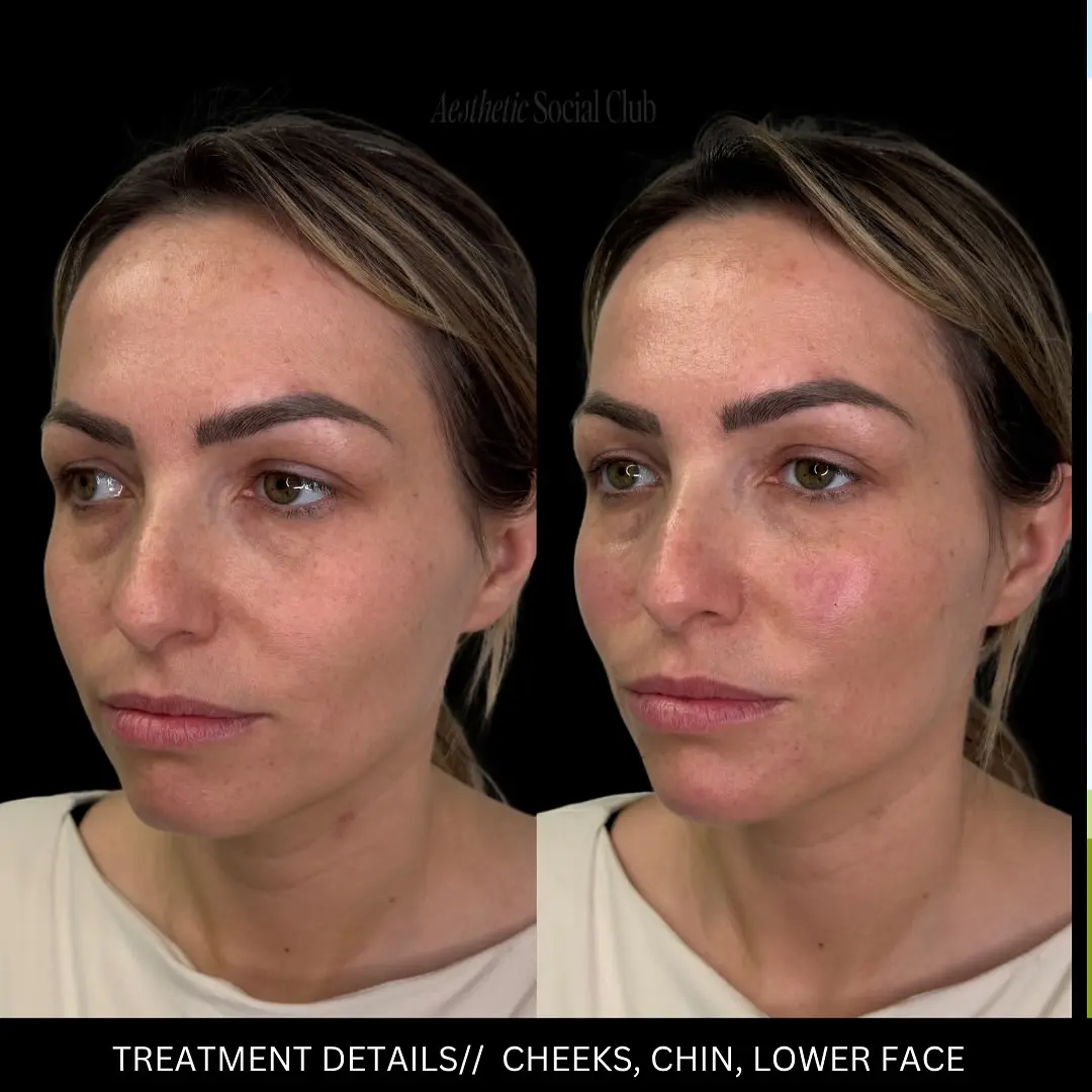 Facial Balancing in Akron, OH facail Balacing Before and after 3