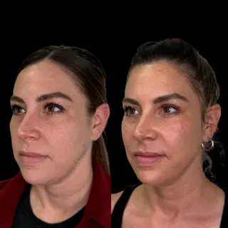 Facial Balancing in Akron, OH facail Balacing Before and after 4