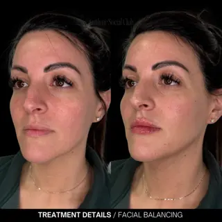Facial Balancing in Akron, OH facail Balacing Before and after 5