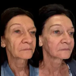 Sculptra Injections In Akron, OH relux med spa Sculptra before and after