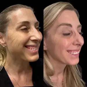 Sculptra Injections In Akron, OH relux med spa Sculptra before and after.webp