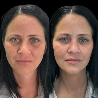 Sculptra Injections In Akron, OH sculptra ba1