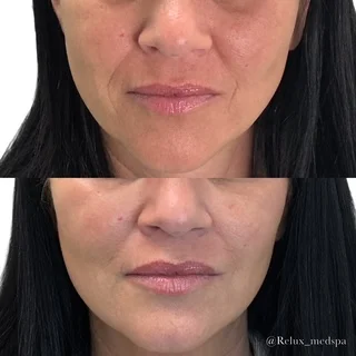 Sculptra Injections In Akron, OH sculptra ba2