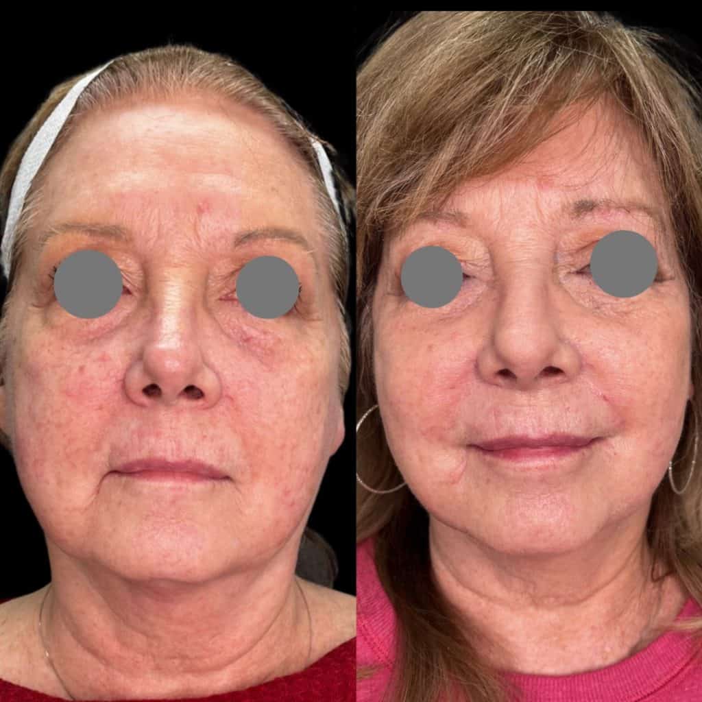 Lifting Threads Treatment at ReLux Medical Spa in Akron, Ohio.