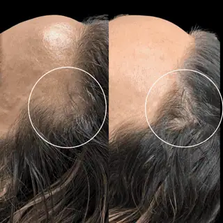 Before And After Natural Growth Factor In Akron, OH | ReLux Medical Spa in Akron, OH